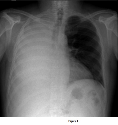 radiografía de tórax derrame pleural